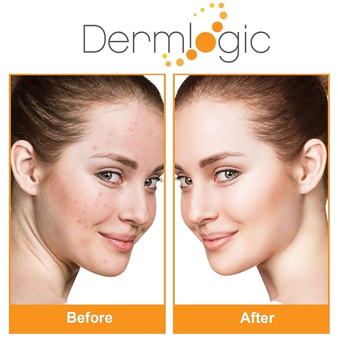 Acne Treatment Pads- Contains Salicylic, Glycolic, & Lactic Acid for Face & Body. Clears Away Clogged Pores, Oily Skin & Cystic Breakouts. Removes Dark Spots, Blackhead & Whitehead Pimples