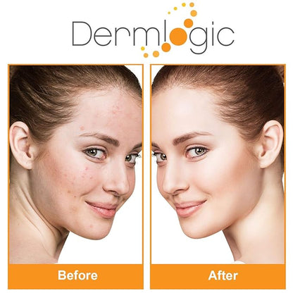 Acne Treatment Pads- Contains Salicylic, Glycolic, & Lactic Acid for Face & Body. Clears Away Clogged Pores, Oily Skin & Cystic Breakouts. Removes Dark Spots, Blackhead & Whitehead Pimples