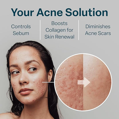 QRxLabs Glycolic/Salicylic Acid 10/2 Acne Control Pads with 10% Ultra Pure Glycolic + 2% Salicylic Acid, Allantoin, Vitamins B5, C & E, Calendula Green Tea - Most Effective Treatment Clear Skin - 2PK