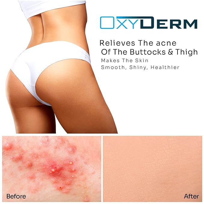 Butt & thigh Acne Treatment Pads - Exfoliating Pads to Eliminate Acne Causing Bacteria. Removes Pimples, Blemishes & Ingrown Hairs for the Buttocks & Thigh Area for Both Men & Women.