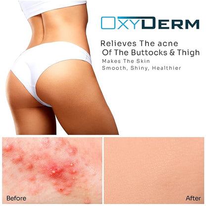 Butt & thigh Acne Treatment Pads - Exfoliating Pads to Eliminate Acne Causing Bacteria. Removes Pimples, Blemishes & Ingrown Hairs for the Buttocks & Thigh Area for Both Men & Women.