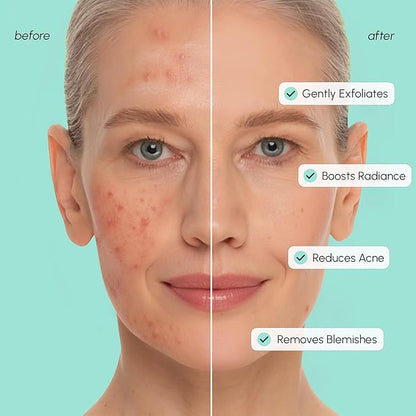 MAREE Azelaic Acid Toner Pads – Exfoliating Pads with Glycolic & Hyaluronic Acid for Face – 10% Azalecic Acid & Centella Redness Soothing Pad – Zero Pore Facial Acne Care Toning Pad – Acido Azelaico