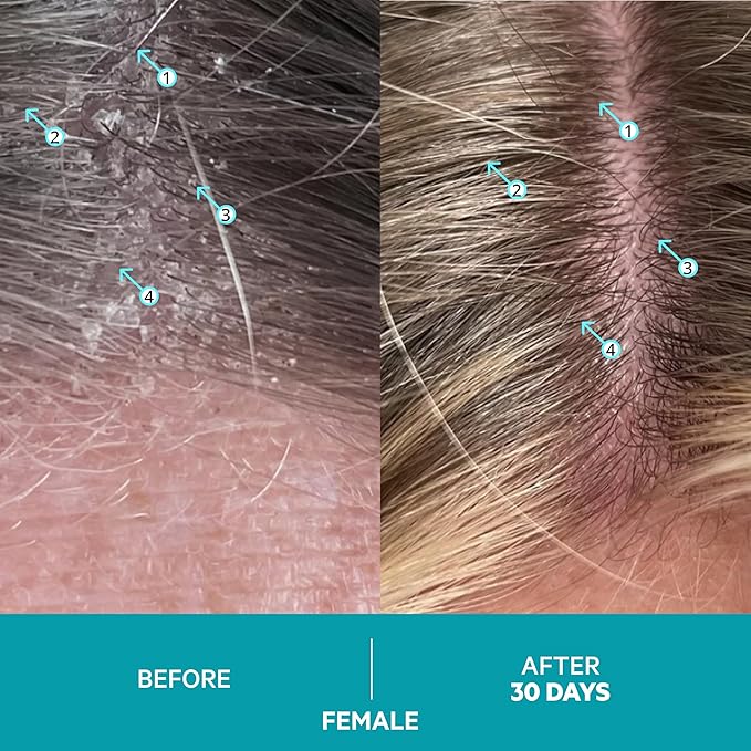 DS Labs Dandrene Dandruff Conditioner, 205mL - for Itchy, Flaky Scalp, Moisturizing Conditioner with Aloe Vera, Supports Scalp Health & Oil Control, For Seborrheic Dermatitis & Psoriasis