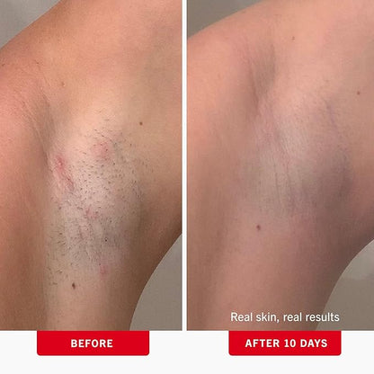 First Aid Beauty - Ingrown Hair Pads with BHA + AHA - Aftershave Treatment Pads to Help Prevent Razor Bumps for Men & Women - Exfoliate Underarms & Bikini Area - Compostable for Daily Use - 60 Pads