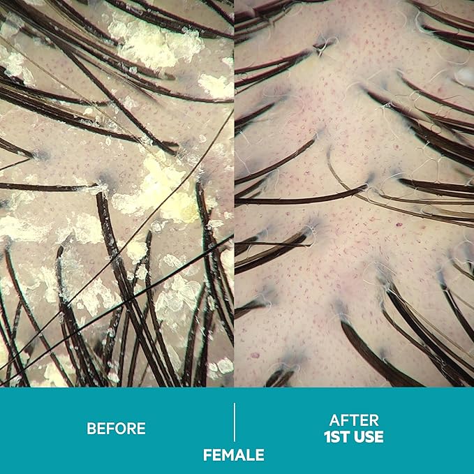 DS Labs Dandrene Dandruff Conditioner, 205mL - for Itchy, Flaky Scalp, Moisturizing Conditioner with Aloe Vera, Supports Scalp Health & Oil Control, For Seborrheic Dermatitis & Psoriasis