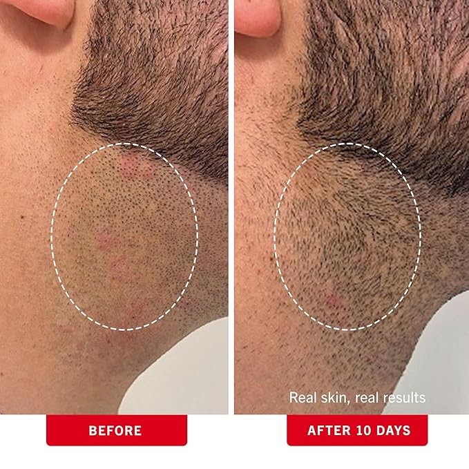 First Aid Beauty - Ingrown Hair Pads with BHA + AHA - Aftershave Treatment Pads to Help Prevent Razor Bumps for Men & Women - Exfoliate Underarms & Bikini Area - Compostable for Daily Use - 60 Pads