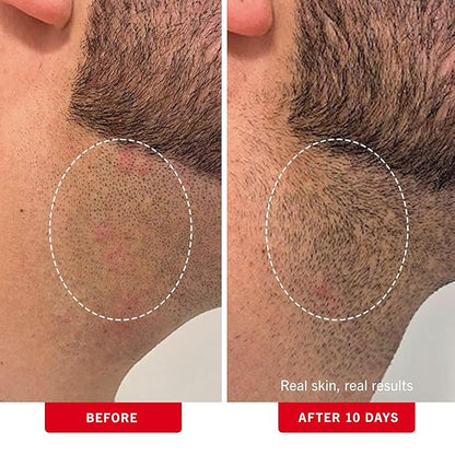 First Aid Beauty - Ingrown Hair Pads with BHA + AHA - Aftershave Treatment Pads to Help Prevent Razor Bumps for Men & Women - Exfoliate Underarms & Bikini Area - Compostable for Daily Use - 60 Pads